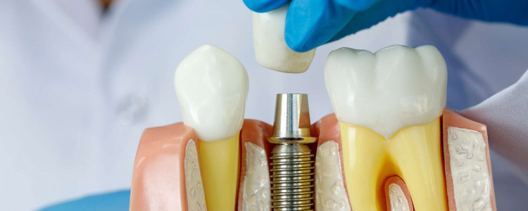 Кому необходима имплантация зубов?